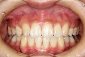 右上は犬歯が本来側切歯の位置に並んでいます。